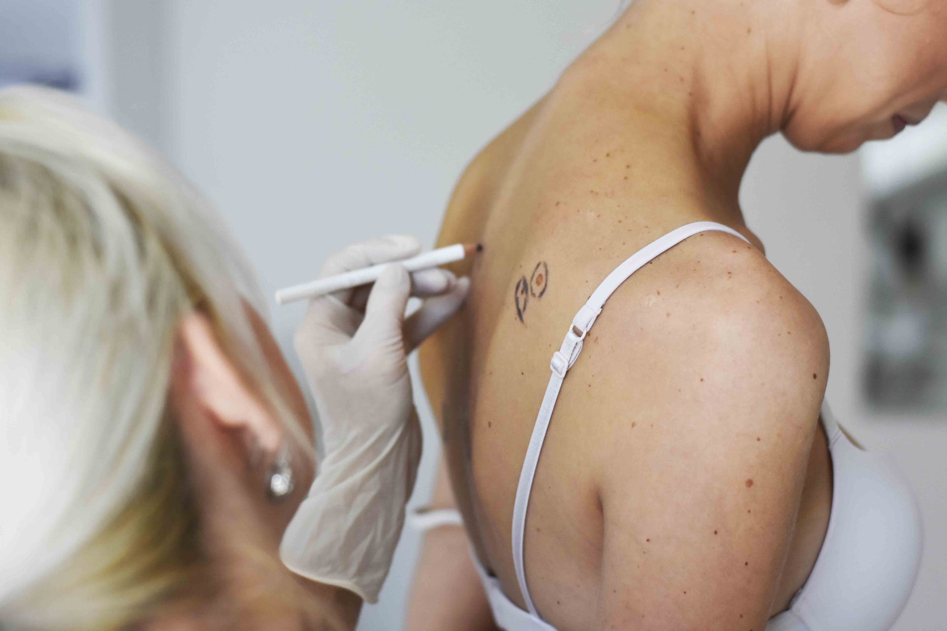 surgical-removal-mark