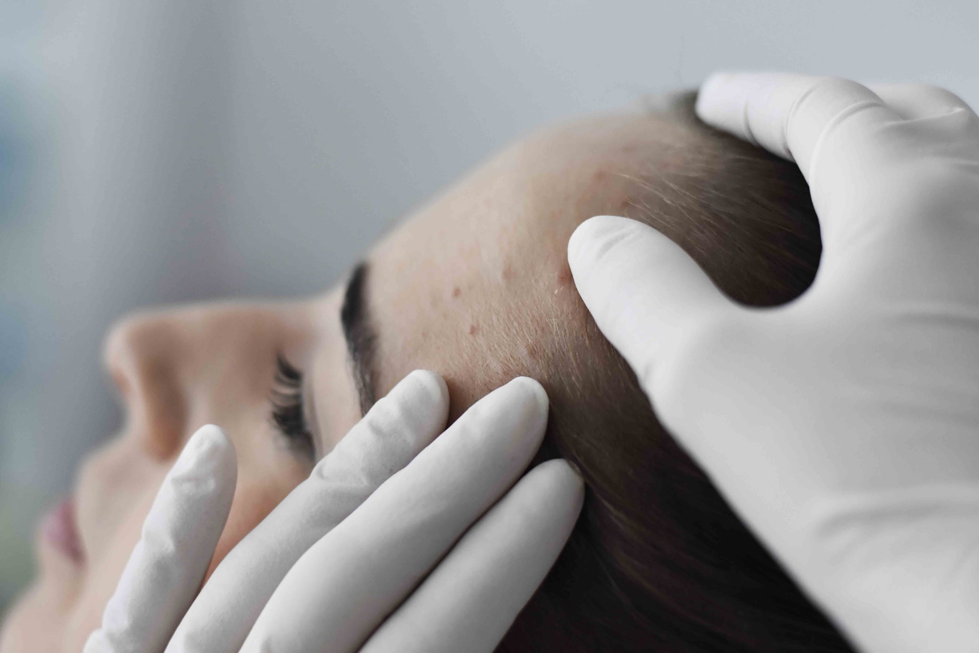 treatment-eczema
