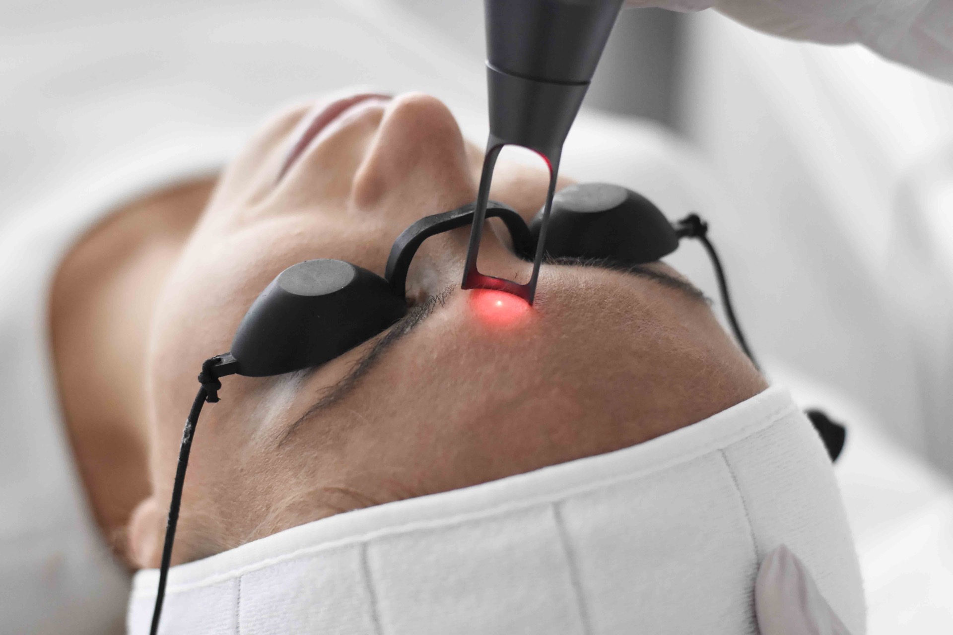 q-switched-laser-pigmentove-skvrny