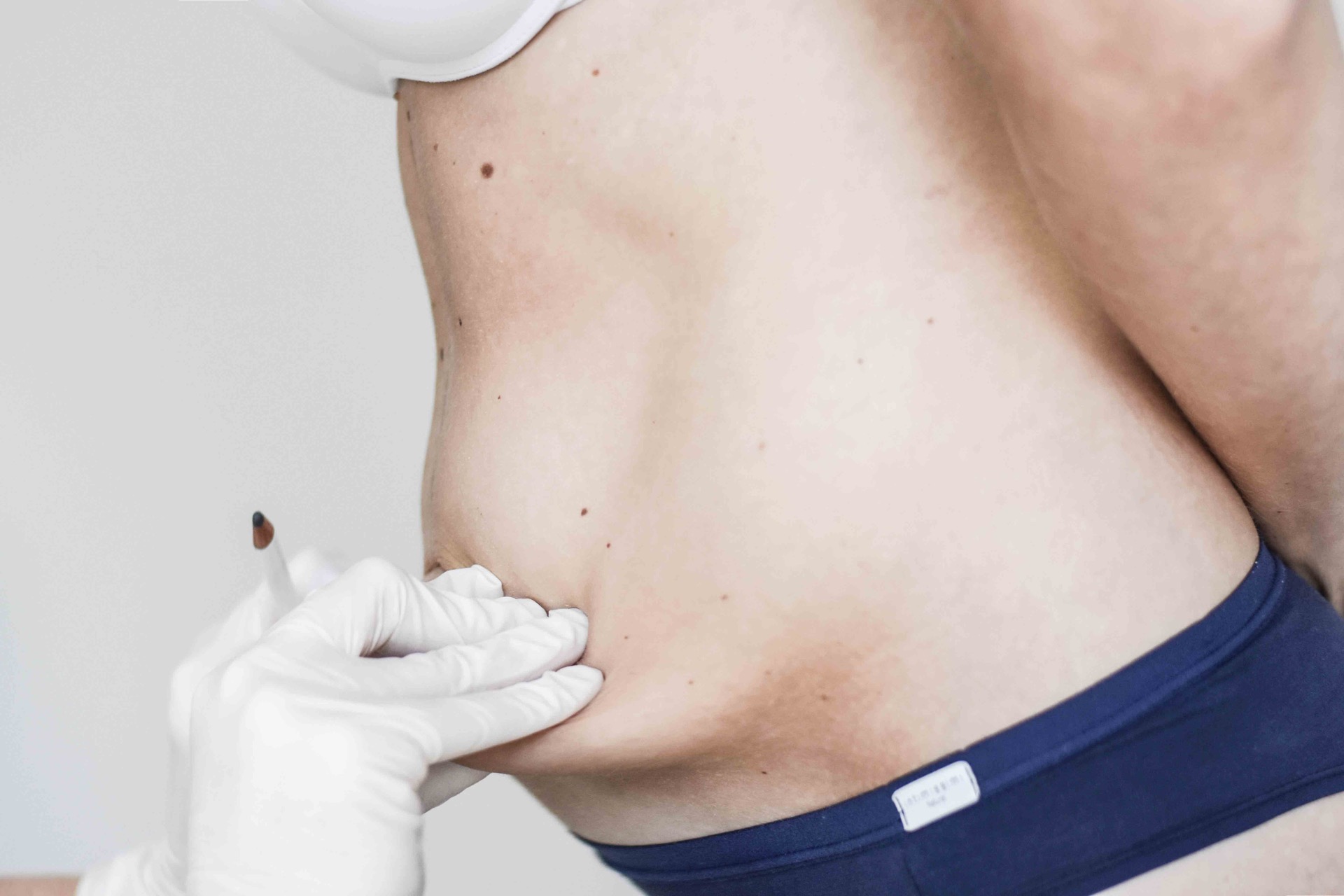 abdominoplastika