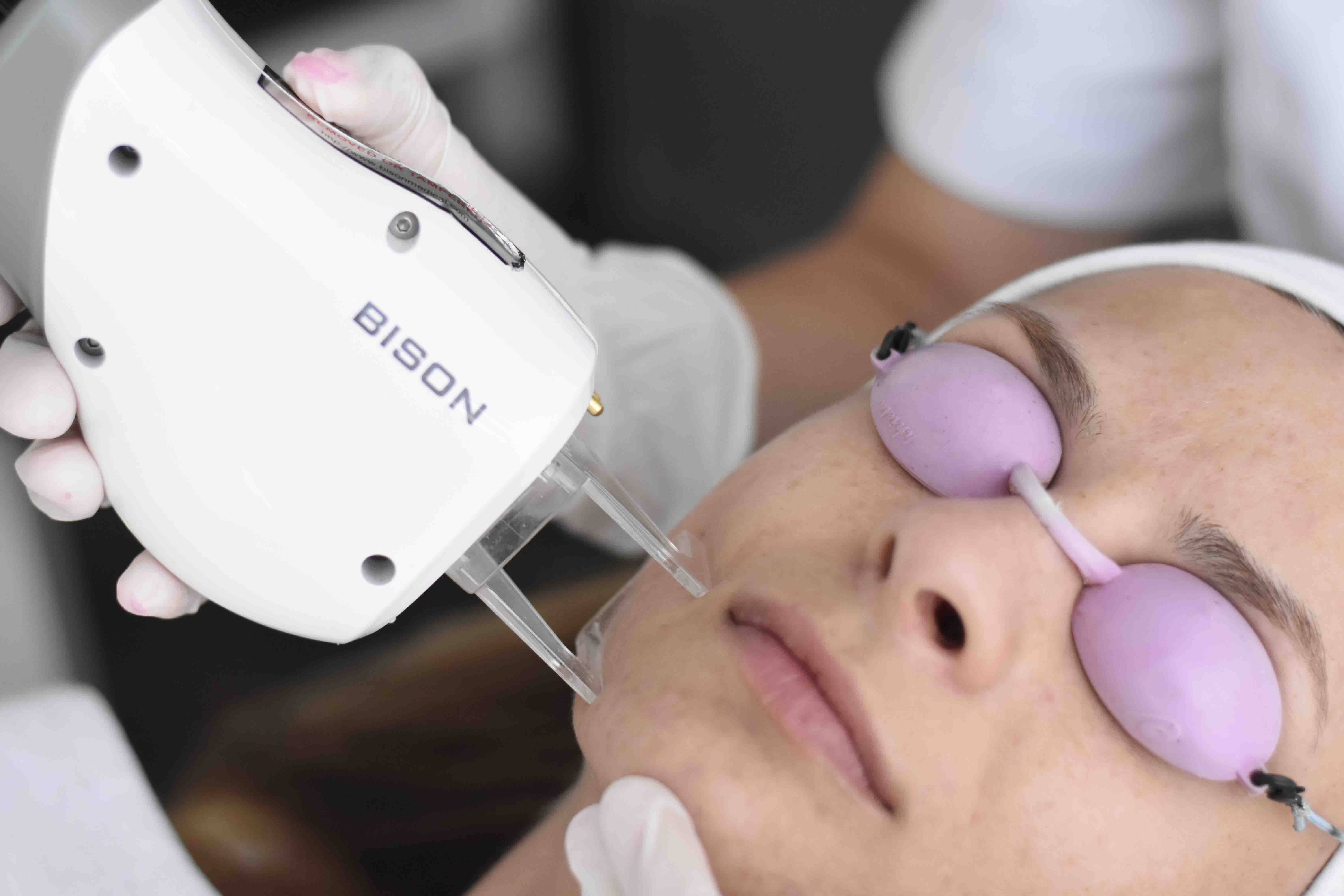 co2-laser-resurfacing