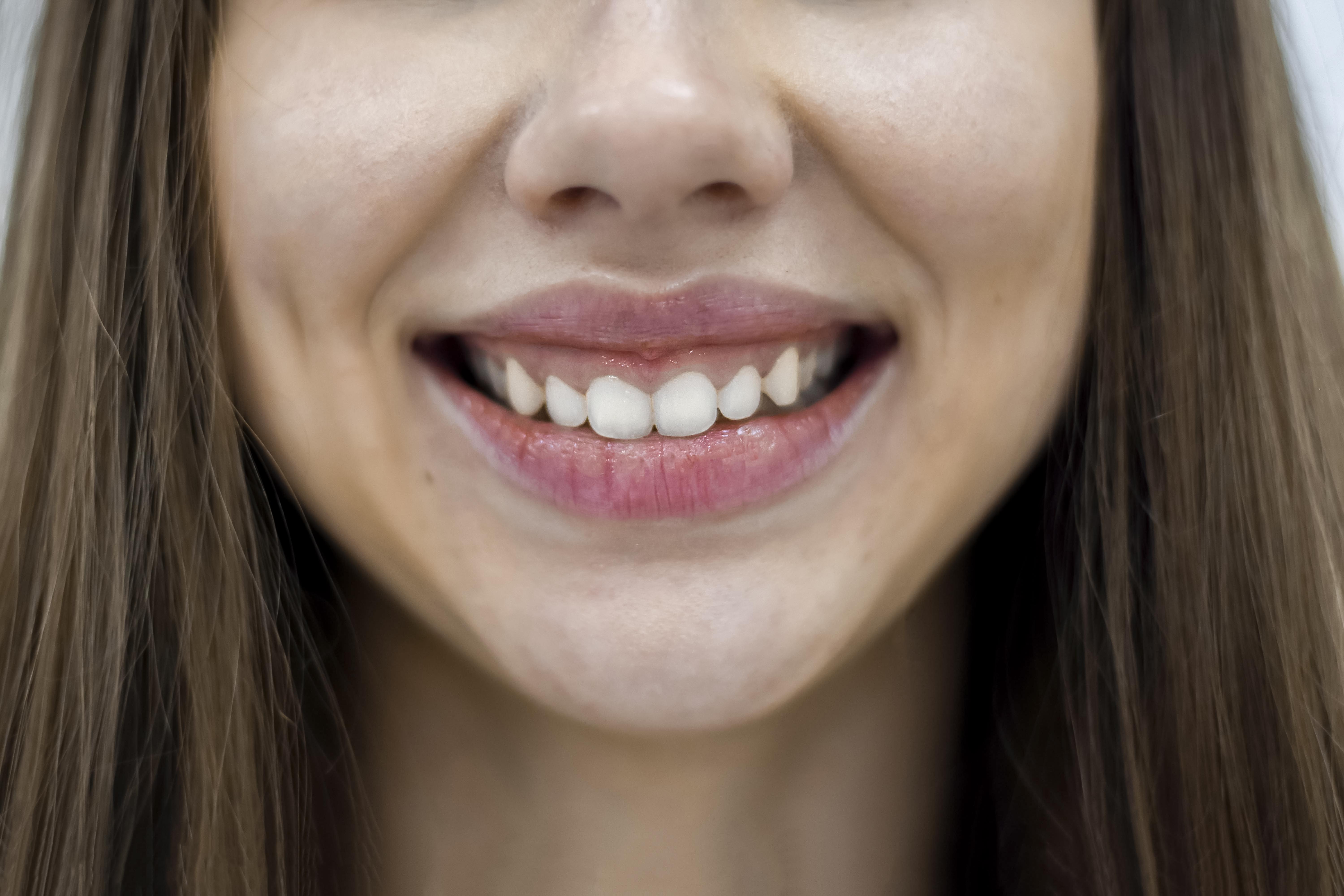 gummy-smile