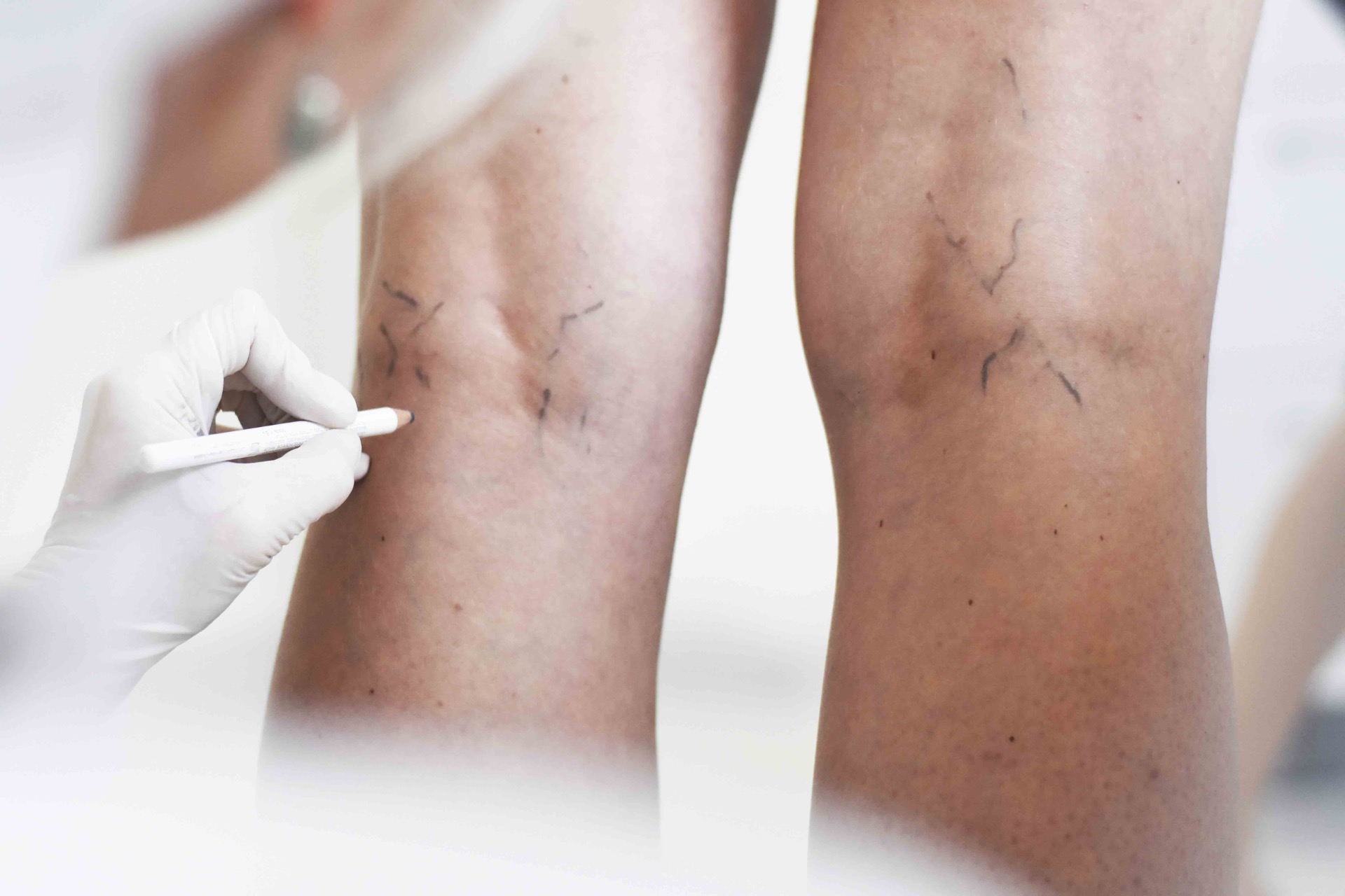 sclerotization-veins