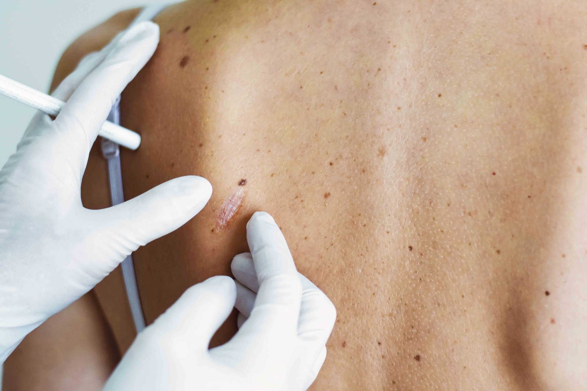diprophos-scar-correction